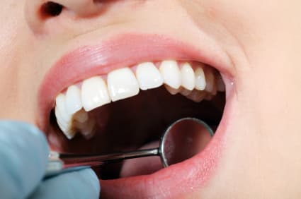 Dental Sealants: Prevent Bacteria From Hiding – Cicero, IL