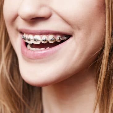 4 Things You Need to Know Before Getting Dental Braces – Cicero, IL