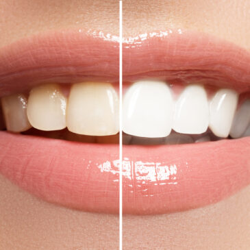 When Should I Get Teeth Whitening?