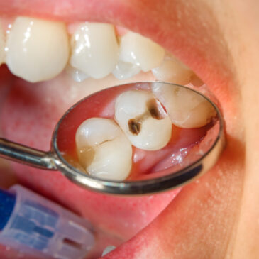 How Do I Know If I Have A Cavity?